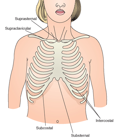 sites of respiratory retractions